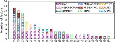 Utility of Biology-Guided Radiotherapy to De Novo Metastases Diagnosed During Staging of High-Risk Biopsy-Proven Prostate Cancer